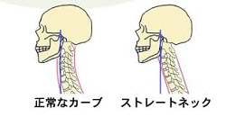 正常なカーブとストレートネック